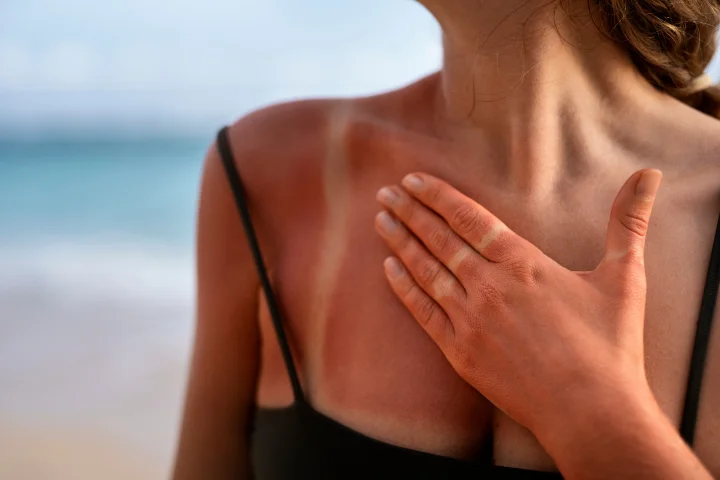 How Does Sunburn Heal? Symptoms, Treatment, and Prevention Methods